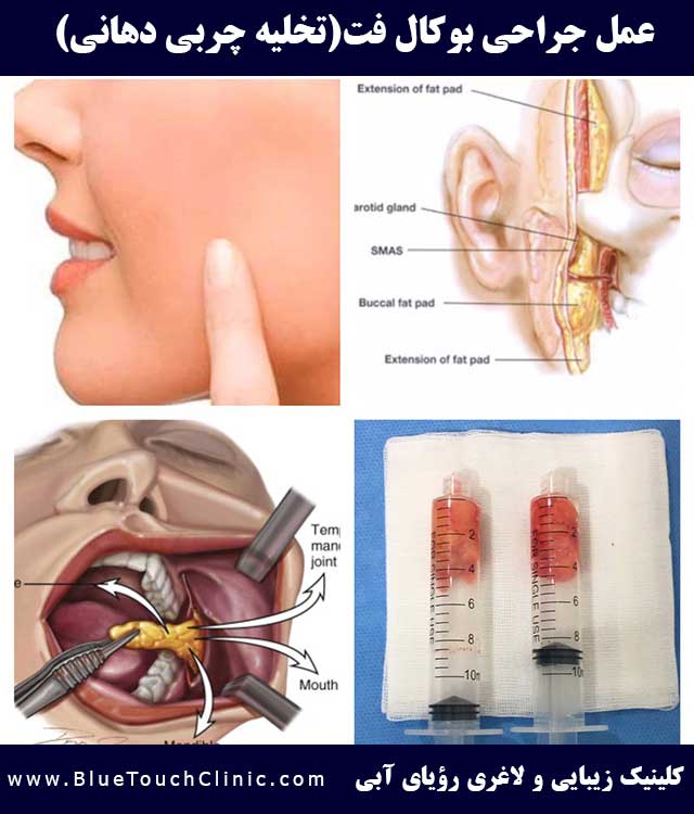 عمل جراحی بوکال فت یا تخلیه چربی دهانی