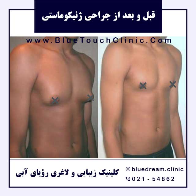 قبل و بعد جراحی کوچیک کردن سینه مردان